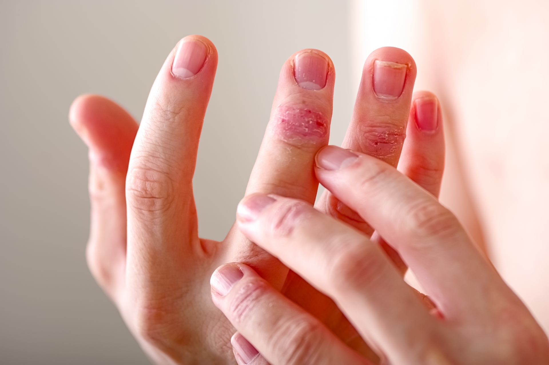 手の皮がむける状態と関連する病気